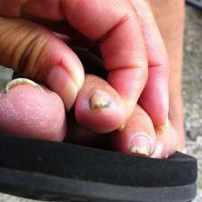 London/St.Thomas Foot Care at Between The Toes | 4856 East St, Port Stanley, ON N5L 1J1, Canada