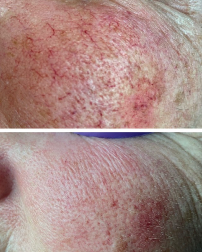 Sophie Esthétique Beauté - Épilation Laser Sherbrooke | 2873 Rue King E, Sherbrooke, QC J1G 5J1, Canada | Phone: (819) 238-9521