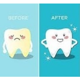 Teeth Whitening | 277 Lawson St, Pickering, ON L1V 5V3, Canada | Phone: (647) 854-7513
