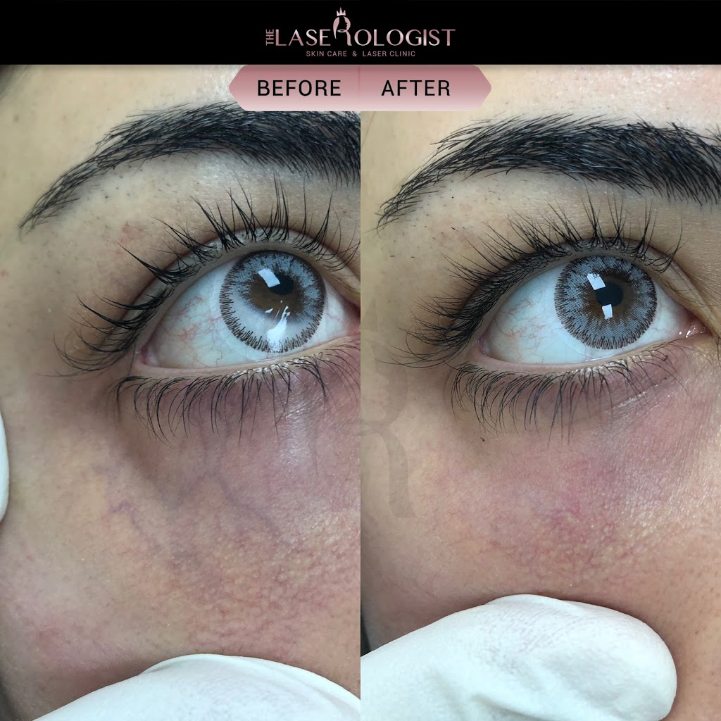 The Laserologist | 69 Bethune Ave, Hannon, ON L0R 1P0, Canada | Phone: (905) 519-7232
