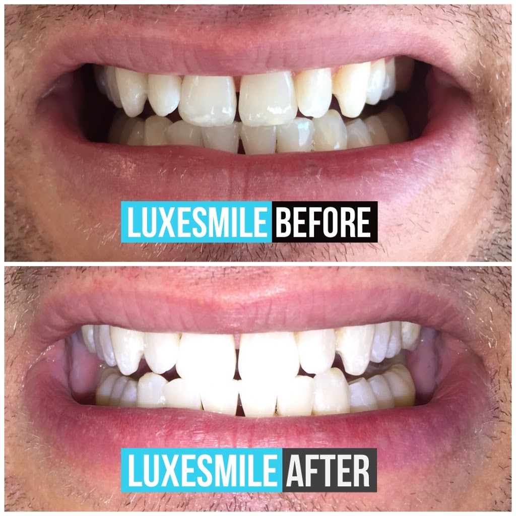 LuxeSmile | Teeth Whitening is all we do! | dentist | 165 Fisher Mills Rd Unit 5, Cambridge, ON N3C 1E1, Canada | 9054696093 OR +1 905-469-6093