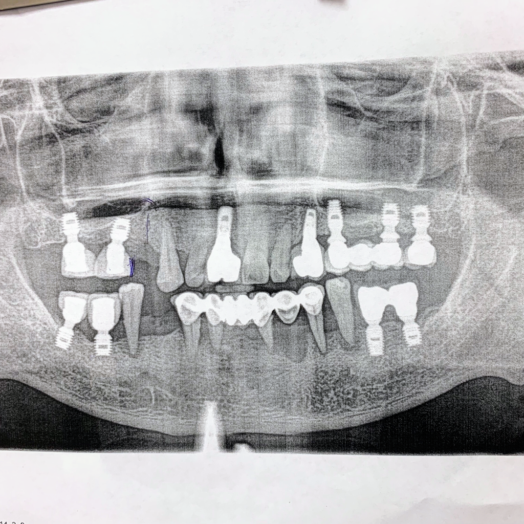 Bellwether Dental Implants & Oral Surgery | 12 Bellwether Way Ste 114, Bellingham, WA 98225, USA | Phone: (360) 366-8026