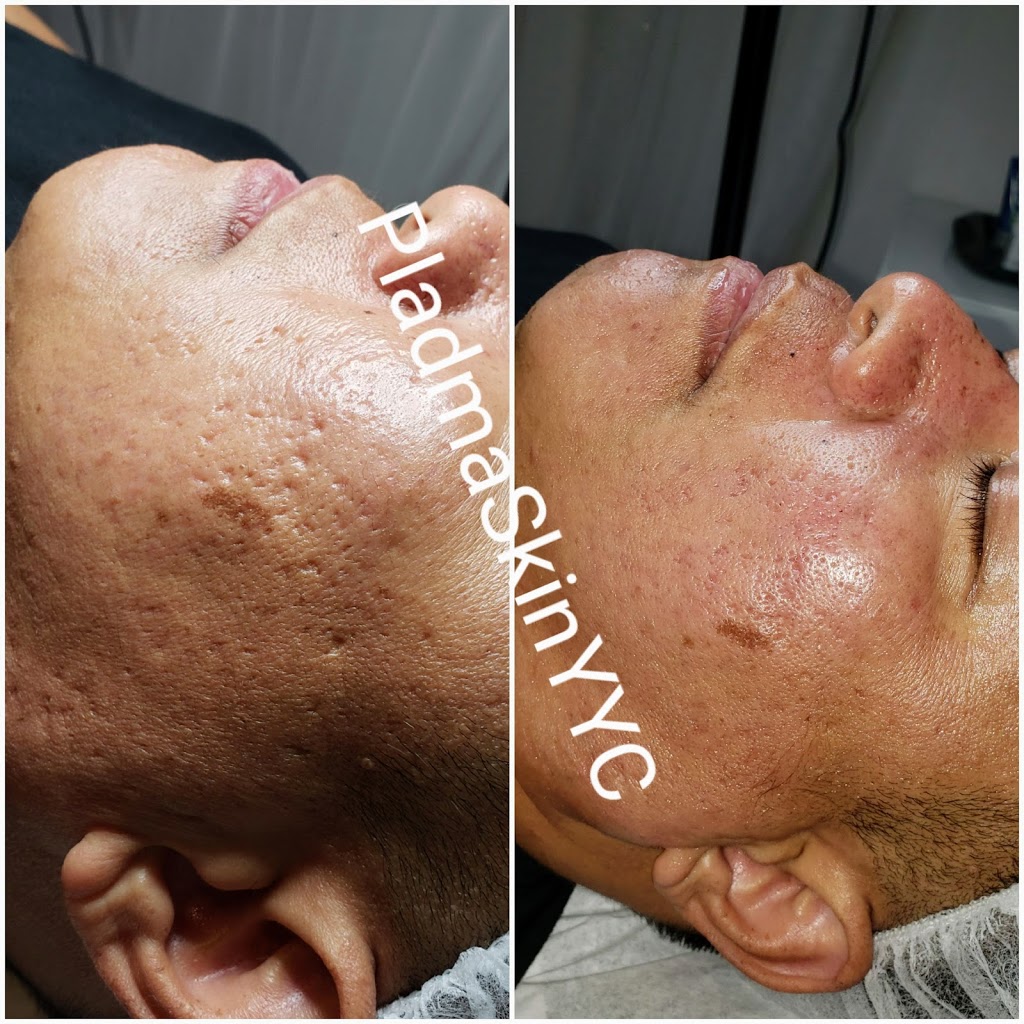 Plasma Skin YYC | 152 Walden Rise, Calgary, AB T2X 0N4, Canada | Phone: (403) 710-5381