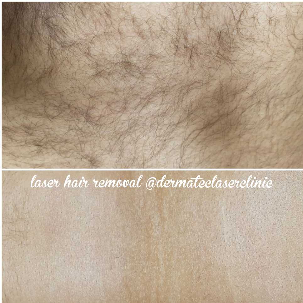 Dermatec Permanent Cosmetic and Laser Clinic | 6499 122a St, Surrey, BC V3W 3R8, Canada | Phone: (604) 805-4273