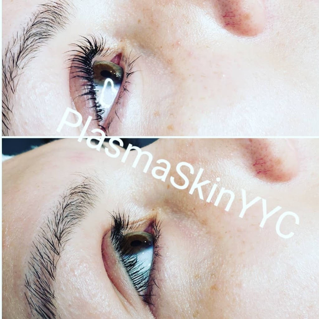 Plasma Skin YYC | 152 Walden Rise, Calgary, AB T2X 0N4, Canada | Phone: (403) 710-5381