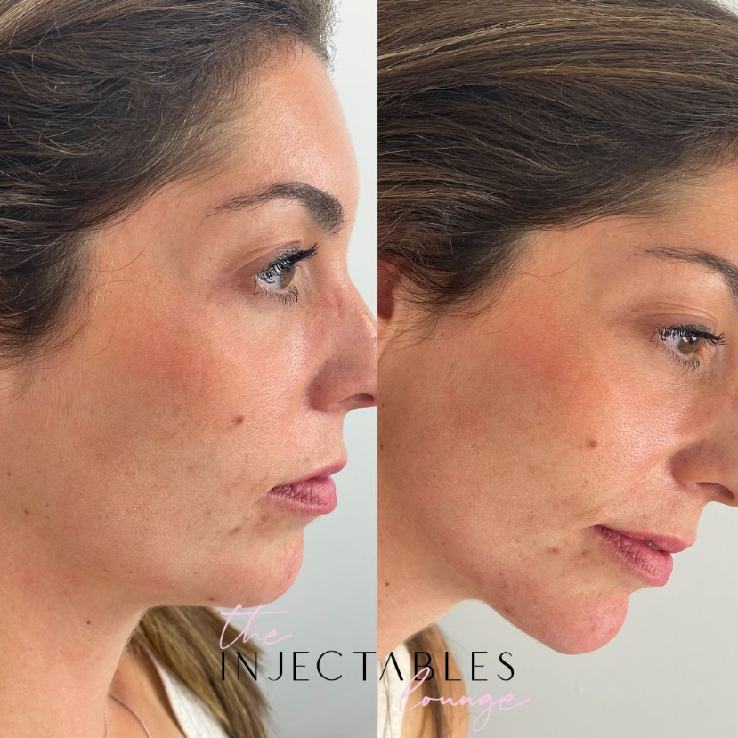 The Injectables Lounge | 190 Wortley Rd Unit 100C, London, ON N6C 4Y7, Canada | Phone: (226) 237-7446