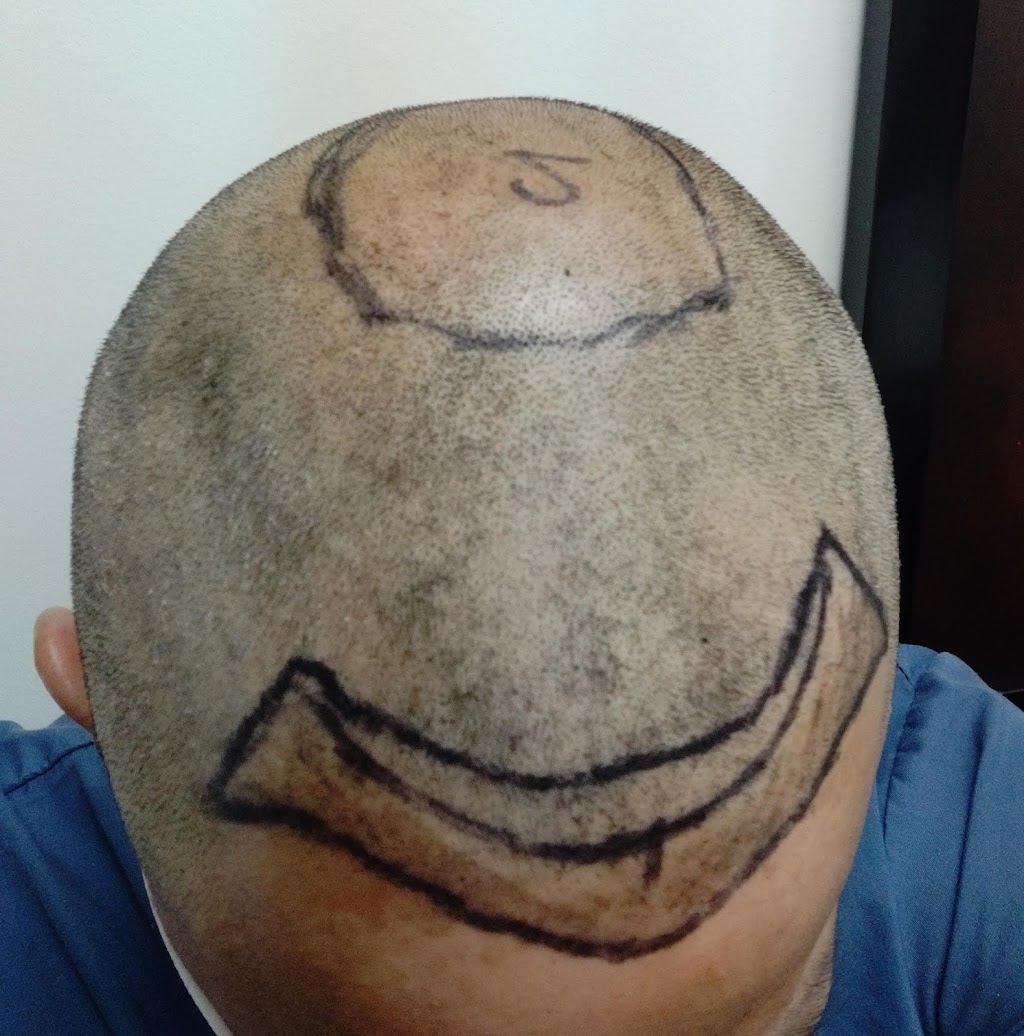 NuHair Medical Hair Transplant Centre | 871 Waverley St #3A, Winnipeg, MB R3T 5P4, Canada | Phone: (204) 500-1529