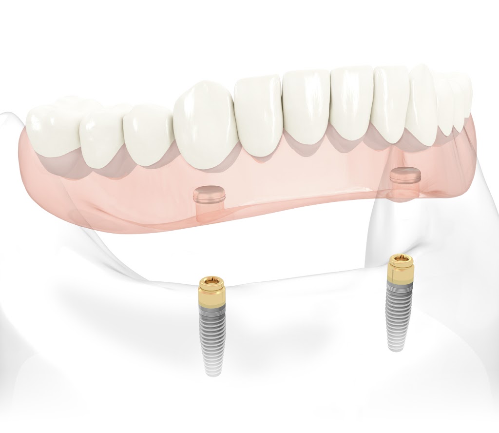 St. Albert Denture and Implant Clinic | 516 St Albert Trail #10, St. Albert, AB T8N 5Z1, Canada | Phone: (780) 459-3437