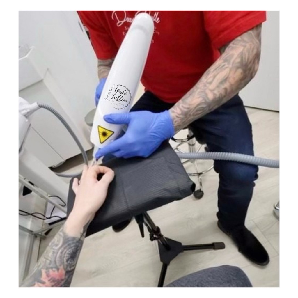 Undo Tattoo Laser Tattoo Removal | 169 Marion St, Winnipeg, MB R2H 0T3, Canada | Phone: (204) 558-8636