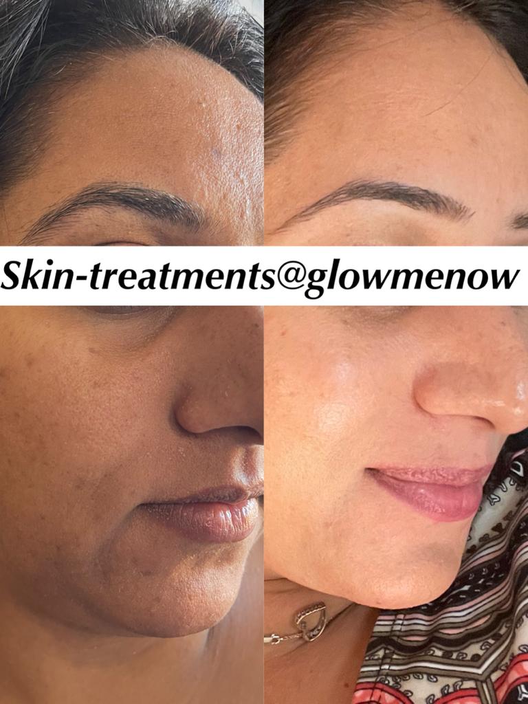 Glow Me Now Aesthetic Lounge & Medi Spa | 1199 Alberni Rd, Woodstock, ON N4T 0H9, Canada | Phone: (647) 767-3349