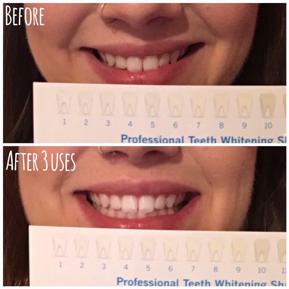 Prestige Teeth Whitening | dentist | 3485 Bliss Crescent, Prince Albert, SK S6V 7J8, Canada | 3069807585 OR +1 306-980-7585