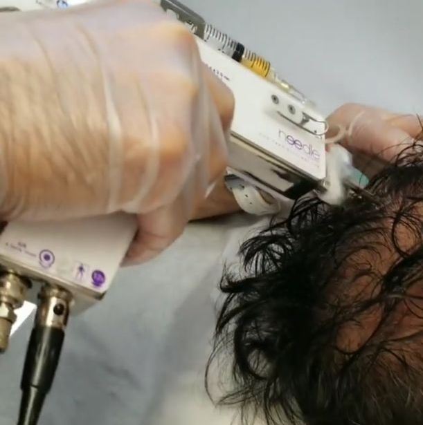weinject | 1092 Islington Ave Suite 201, Etobicoke, ON M8Z 4R9, Canada | Phone: (647) 804-6712