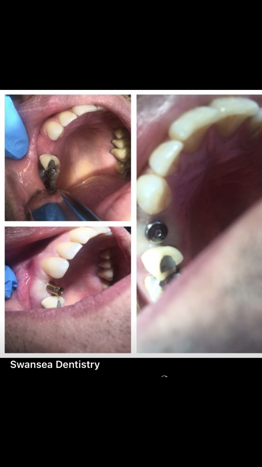 Swansea Dentistry | 2489 Bloor St W #103, Toronto, ON M6S 1R6, Canada | Phone: (416) 766-8005