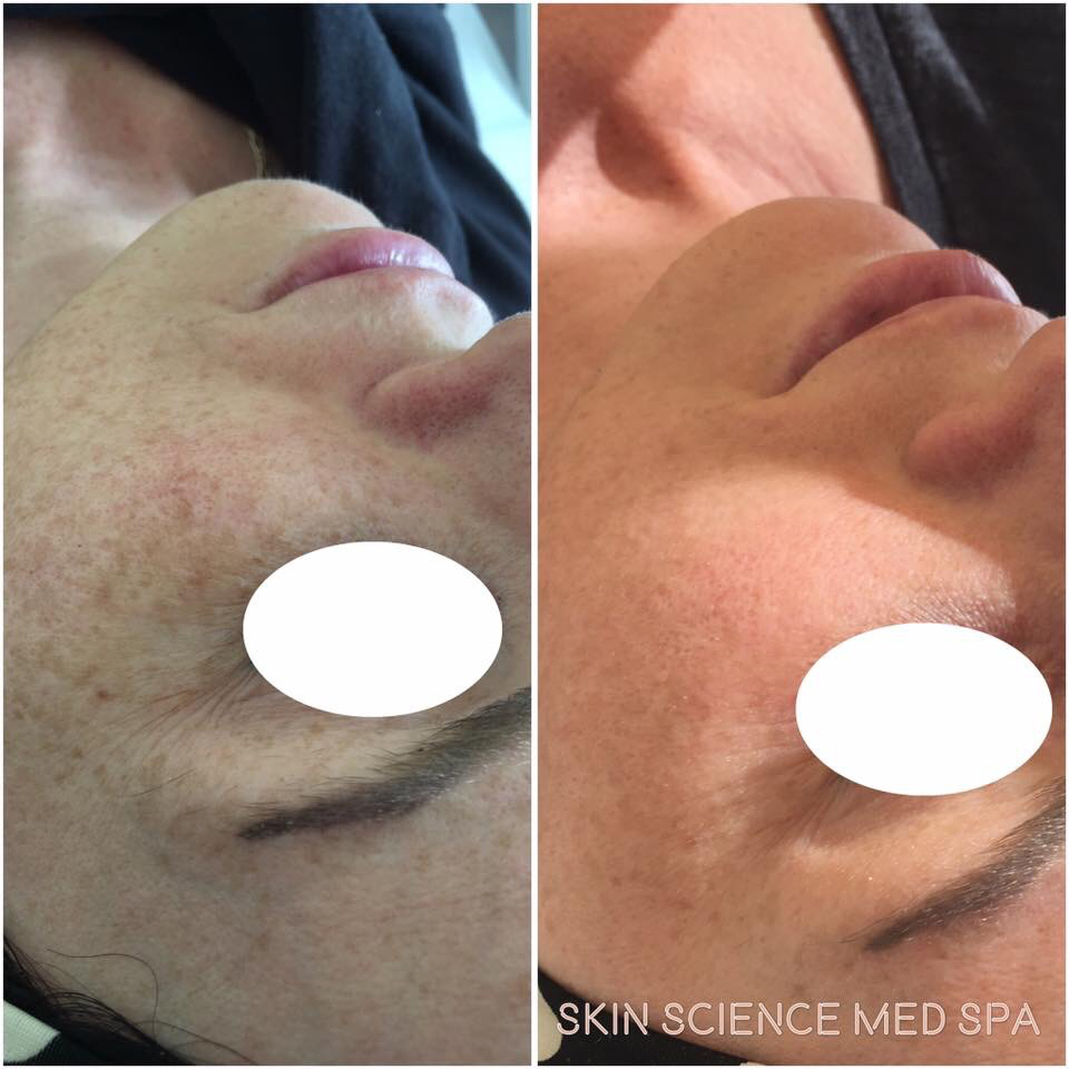 Skin Science Med Spa | 170 N Queen St K, Etobicoke, ON M9C 1A8, Canada | Phone: (416) 939-8395