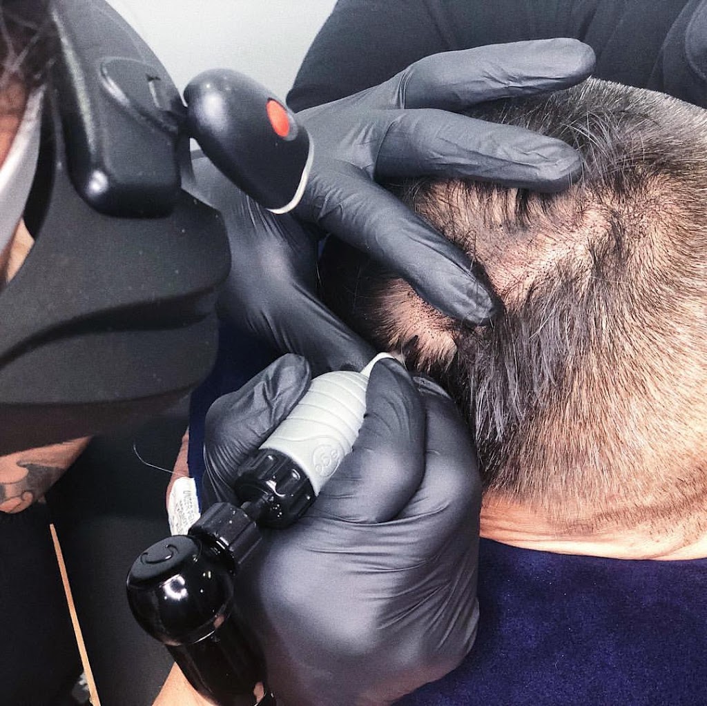 Scalp Micropigmentation by Chronic Ink - Markham | 7381 Kennedy Rd Unit #105, Markham, ON L3R 5B5, Canada | Phone: (905) 305-0311
