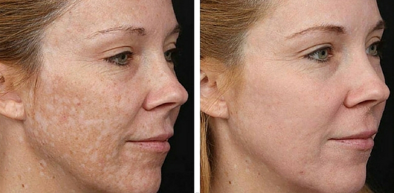 MCI Cosmetic Clinic | 200 Windflower Gate Unit 700, Woodbridge, ON L4L 9L3, Canada | Phone: (905) 856-2100 ext. 205