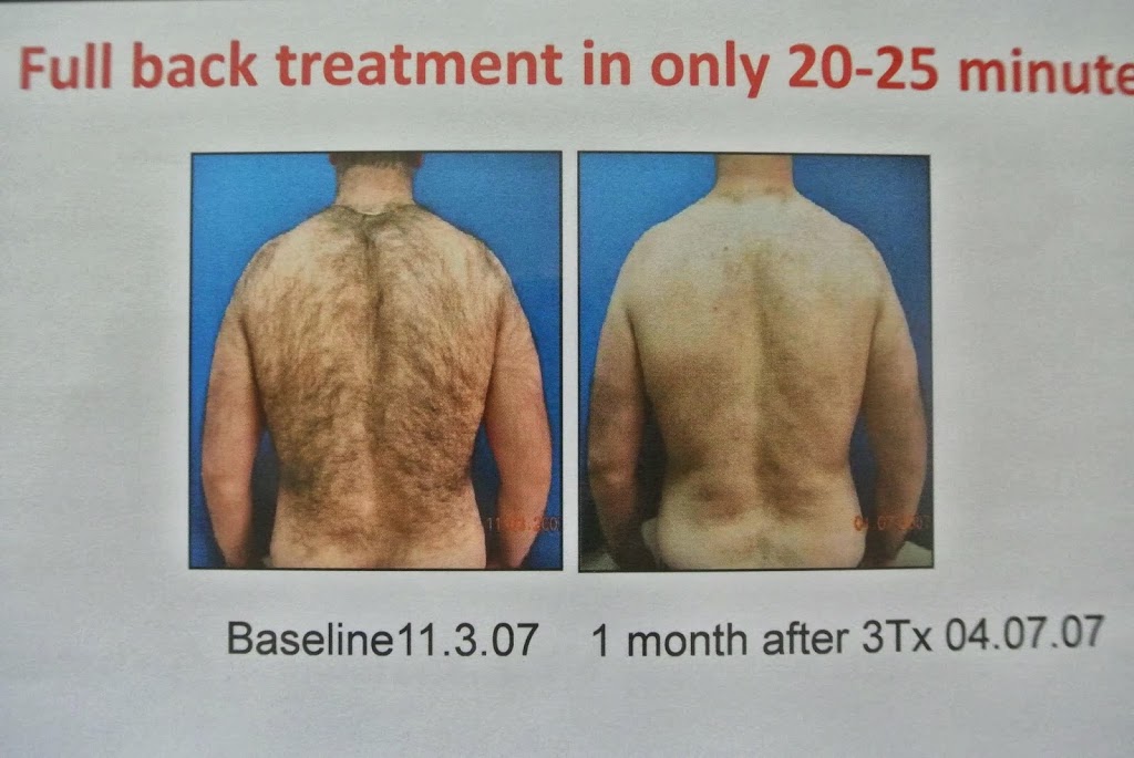 Advanced Laser Hair Removal | 2063 146 Ave SE, Calgary, AB T2J 6C3, Canada | Phone: (587) 777-0323