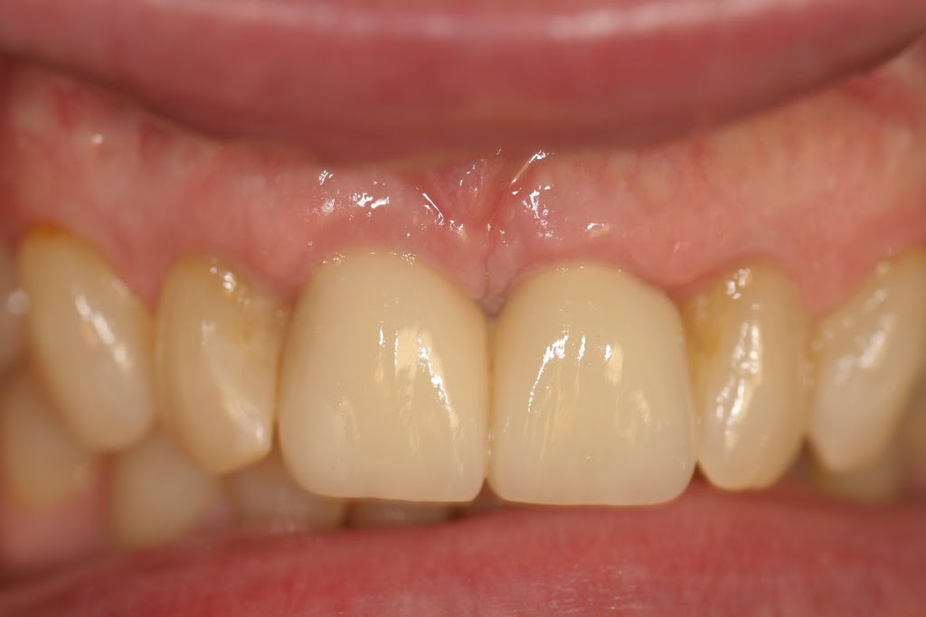 Implant Restorations Inc | 661 Sandford Rd, Uxbridge, ON L9P 1R2, Canada | Phone: (866) 802-3623