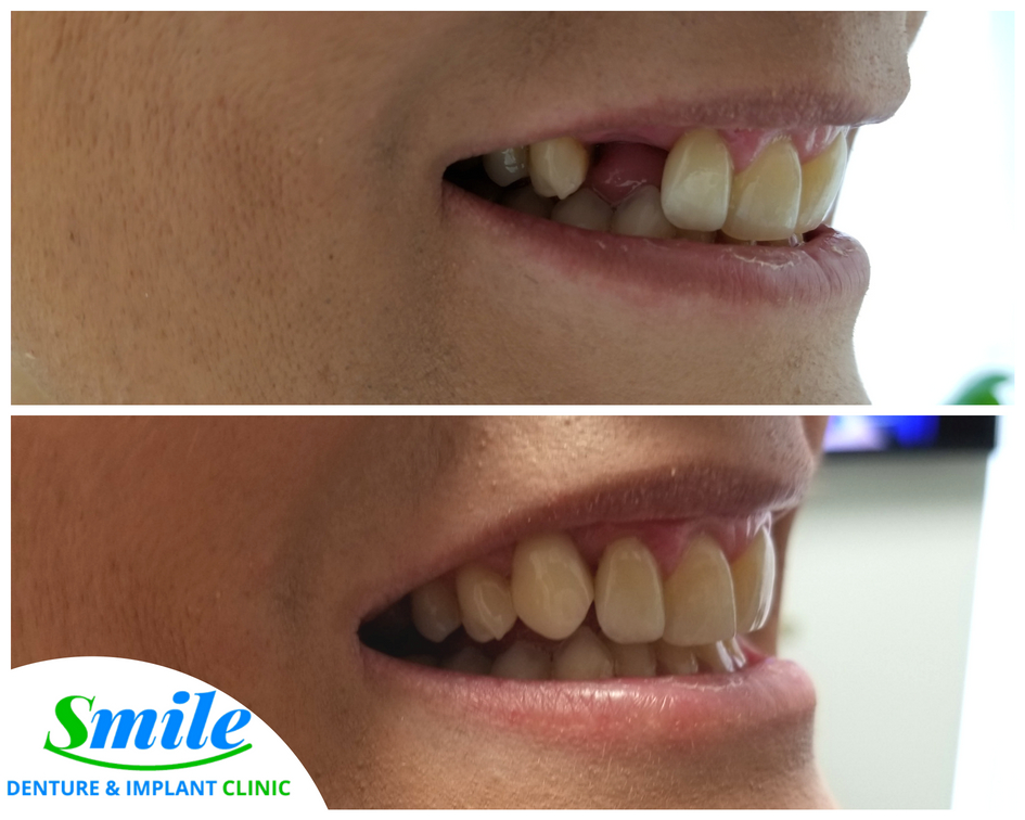 Smile Denture & Implant Clinic | 1825 Woodward Dr, Ottawa, ON K2C 0P9, Canada | Phone: (613) 702-2656