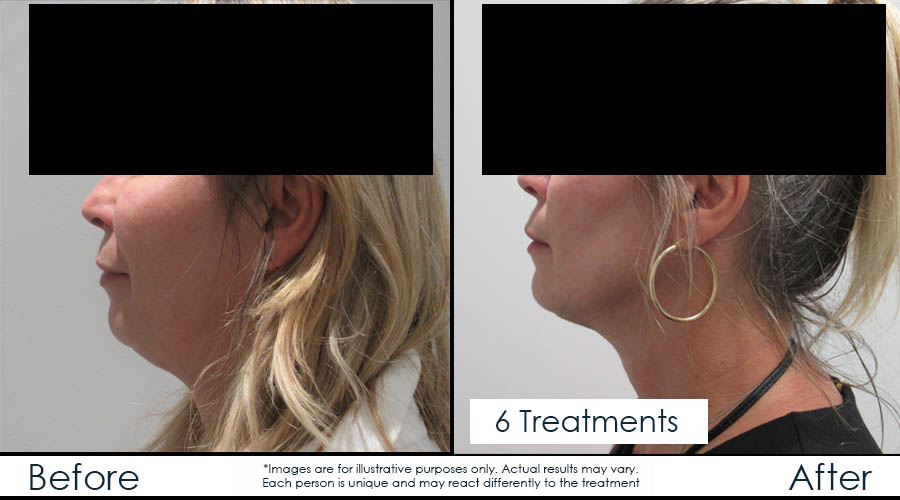 Infinium Médecine Esthétique | 729 Boulevard Saint-Joseph, Gatineau, QC J8Y 4B6, Canada | Phone: (819) 771-4284
