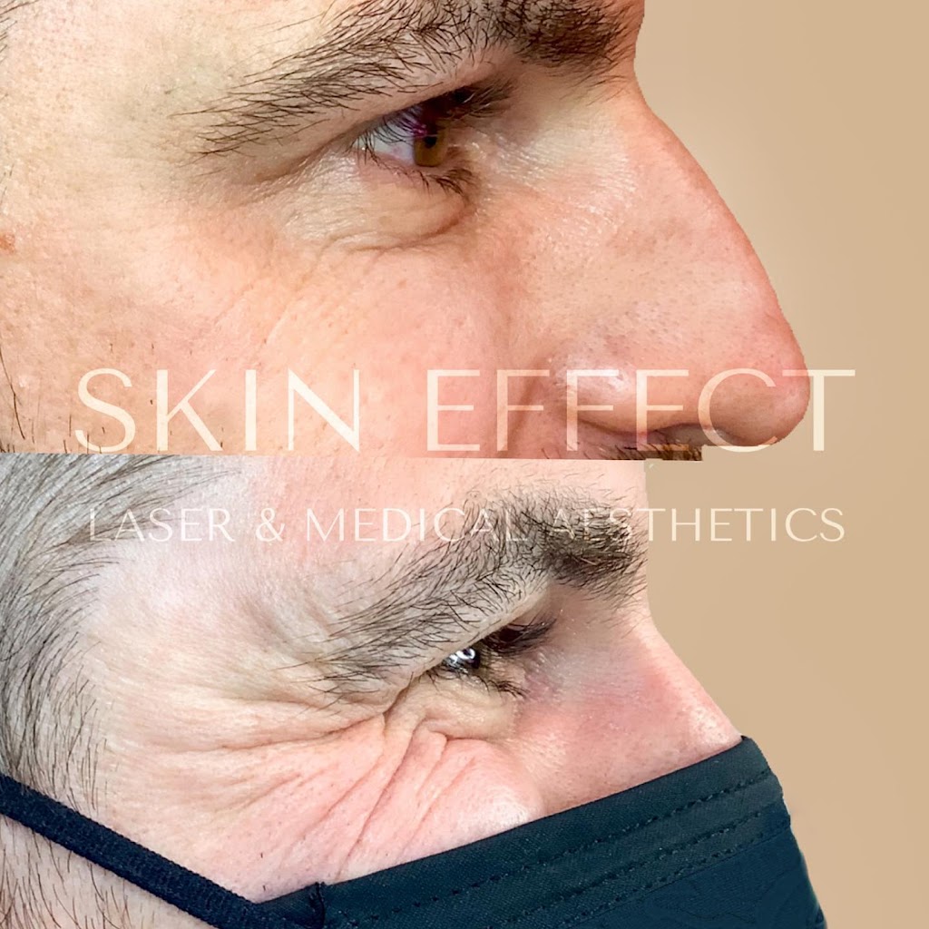Skin Effect Laser and Medical Aesthetics | 10441 99 Ave Unit 701, Fort Saskatchewan, AB T8L 0V6, Canada | Phone: (780) 935-7546