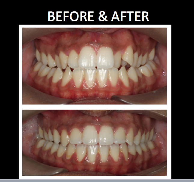 Impressions Orthodontics | 30 Springborough Blvd SW Suite 245, Calgary, AB T3H 0N9, Canada | Phone: (403) 457-7700