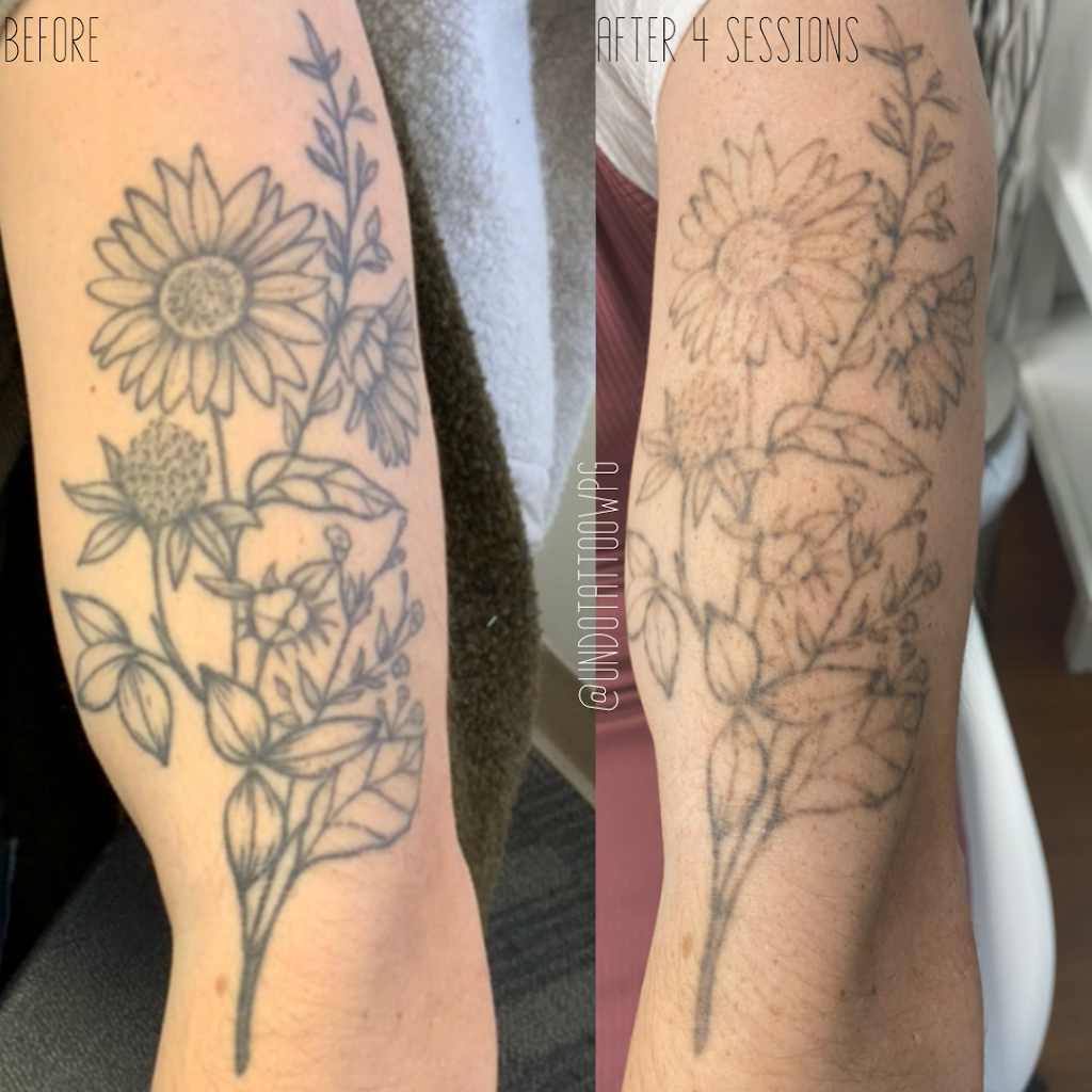 Undo Tattoo Laser Tattoo Removal | 169 Marion St, Winnipeg, MB R2H 0T3, Canada | Phone: (204) 558-8636