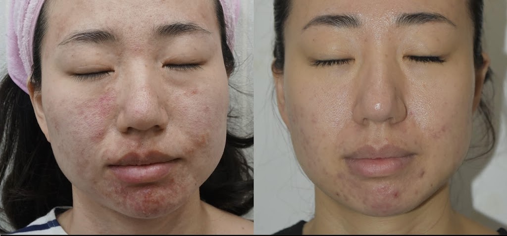 Carewell Laser Esthetics | 6490 Old Banff Coach Rd SW, Calgary, AB T3H 5R8, Canada | Phone: (604) 312-3034