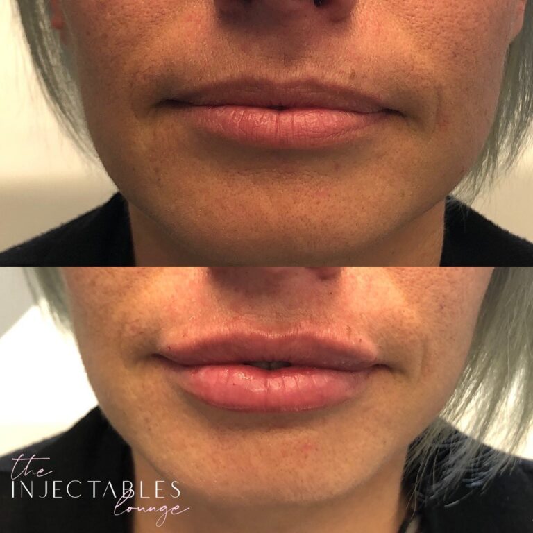 The Injectables Lounge | 190 Wortley Rd Unit 100C, London, ON N6C 4Y7, Canada | Phone: (226) 237-7446