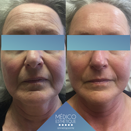 Médico Esthétique Annie Lapointe | 700 Route du Président-Kennedy, Pintendre, QC G6C 1E2, Canada | Phone: (418) 951-6285