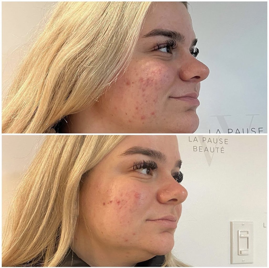 La Pause V Beauté | 1715 Av. Bourgogne, Chambly, QC J3L 1Y8, Canada | Phone: (438) 290-5344