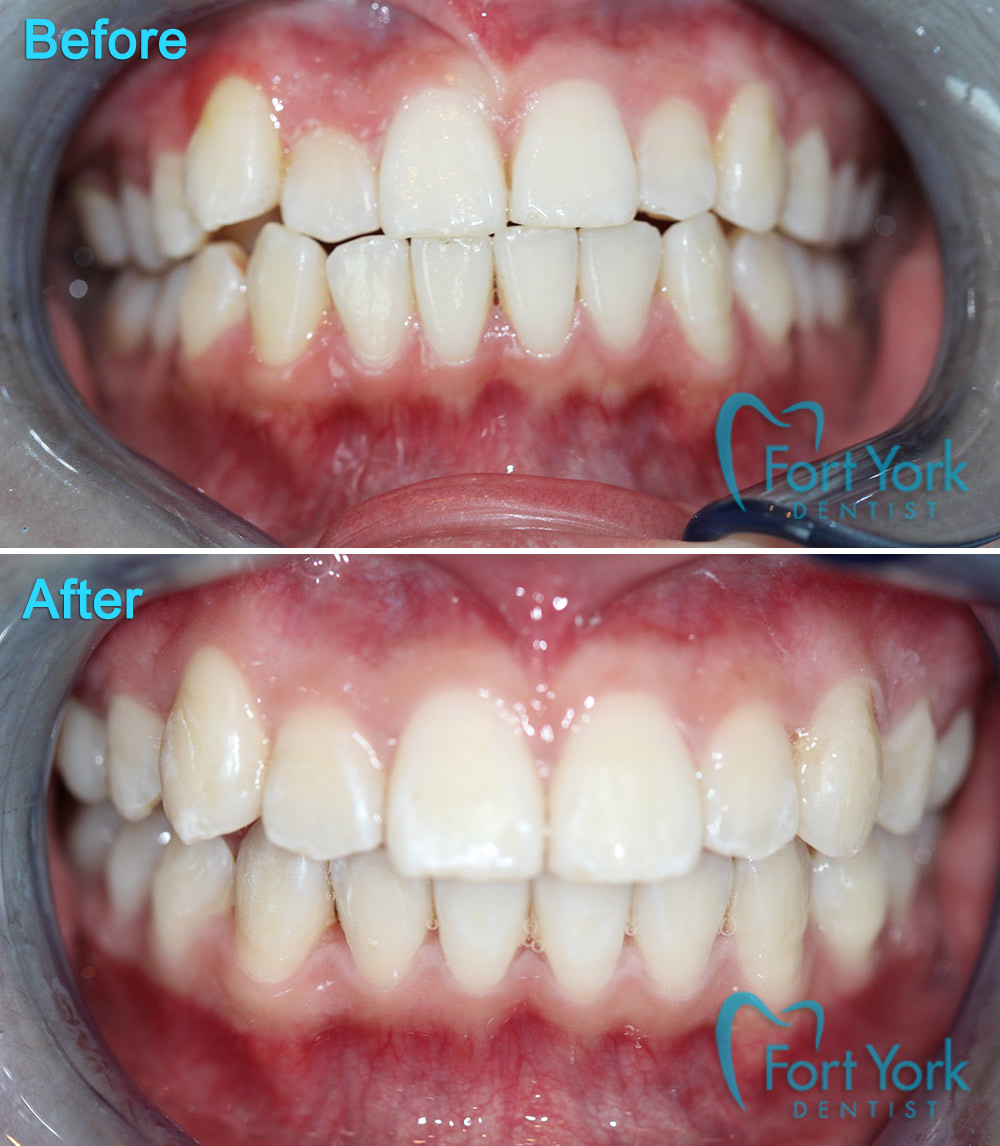 Fort York Dentist Clinic | 219 Fort York Blvd #107, Toronto, ON M5V 1B1, Canada | Phone: (647) 346-8888