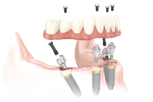 Tooth Care Centre | 6061 York Regional Rd 7, Markham, ON L3P 3B2, Canada | Phone: (905) 554-3555