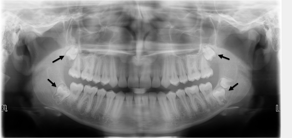 Bellwether Dental Implants & Oral Surgery | 12 Bellwether Way Ste 114, Bellingham, WA 98225, USA | Phone: (360) 366-8026