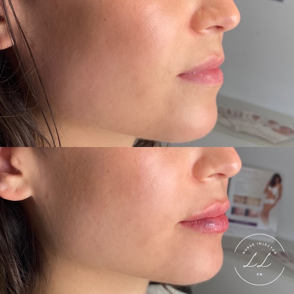 Lauren Landry RN - Halifax Injector: Botox and Dermal Fillers | 6461 Quinpool Rd, Halifax, NS B3L 1B1, Canada | Phone: (902) 789-1174