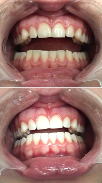 Sensational Smile Whitening | 16748 61 St NW, Edmonton, AB T5Y 0W7, Canada | Phone: (780) 221-6240