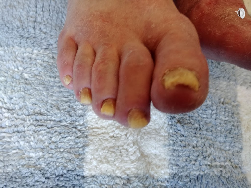 Healthy Feet Mobile Foot Care Services | Gough Ave, London, ON N5X 4P8, Canada | Phone: (519) 933-9155