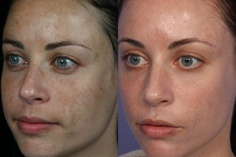 Skin Care Lazer YXE | Sunsera Salon. Ask for Olga (Laser technician, 815 Gray Ave, Saskatoon, SK S7N 2K6, Canada | Phone: (639) 318-9969