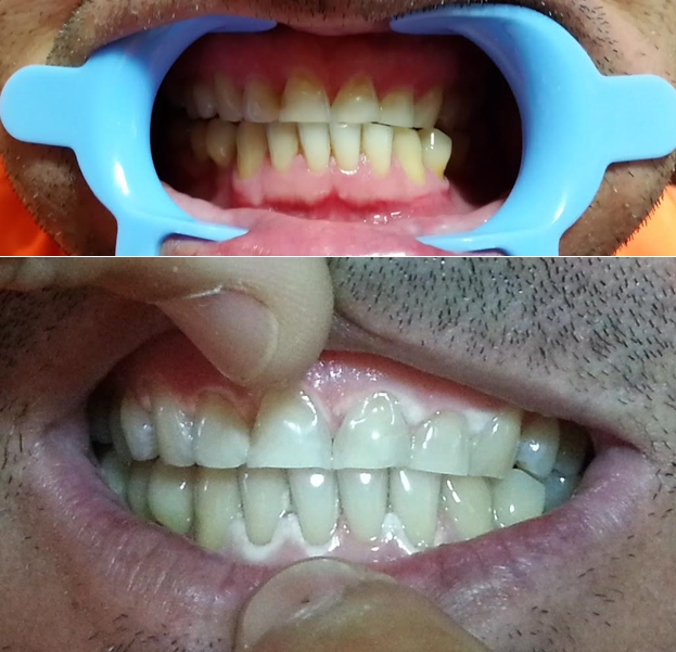 Teeth Whitening | 277 Lawson St, Pickering, ON L1V 5V3, Canada | Phone: (647) 854-7513