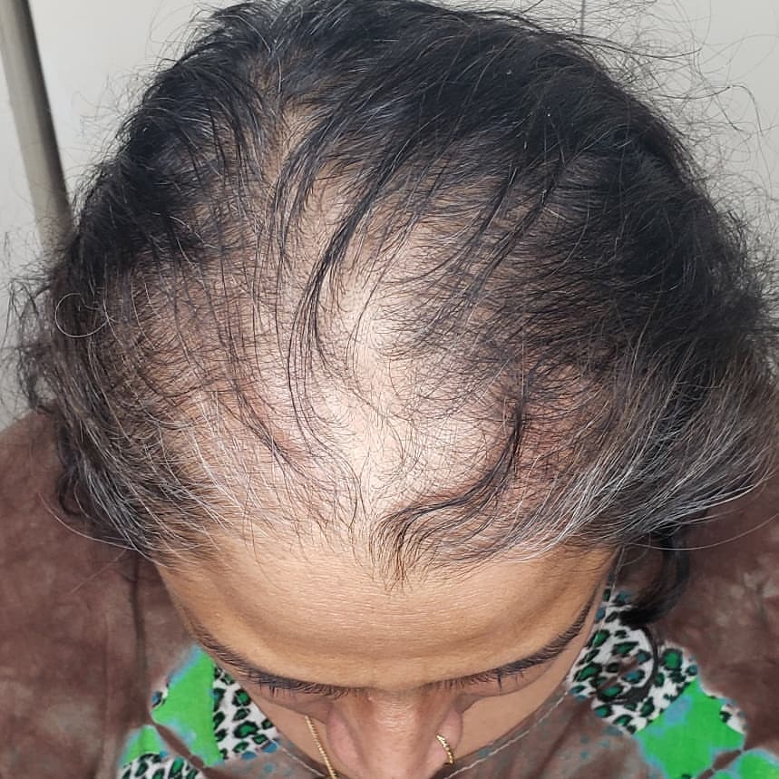Scalp Micropigmentation by Chronic Ink - Markham | 7381 Kennedy Rd Unit #105, Markham, ON L3R 5B5, Canada | Phone: (905) 305-0311