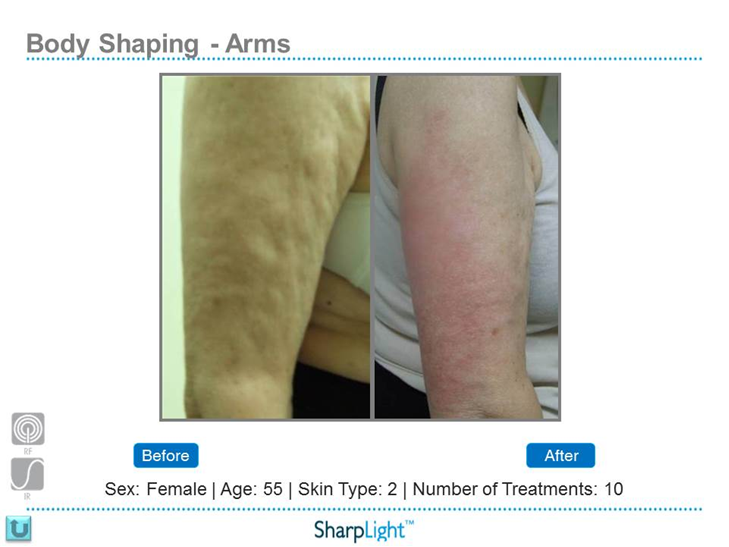 Refresh Laser & Skin Rejuvenation | 901 Heritage Dr SW, Calgary, AB T2V 2W8, Canada | Phone: (403) 464-9417