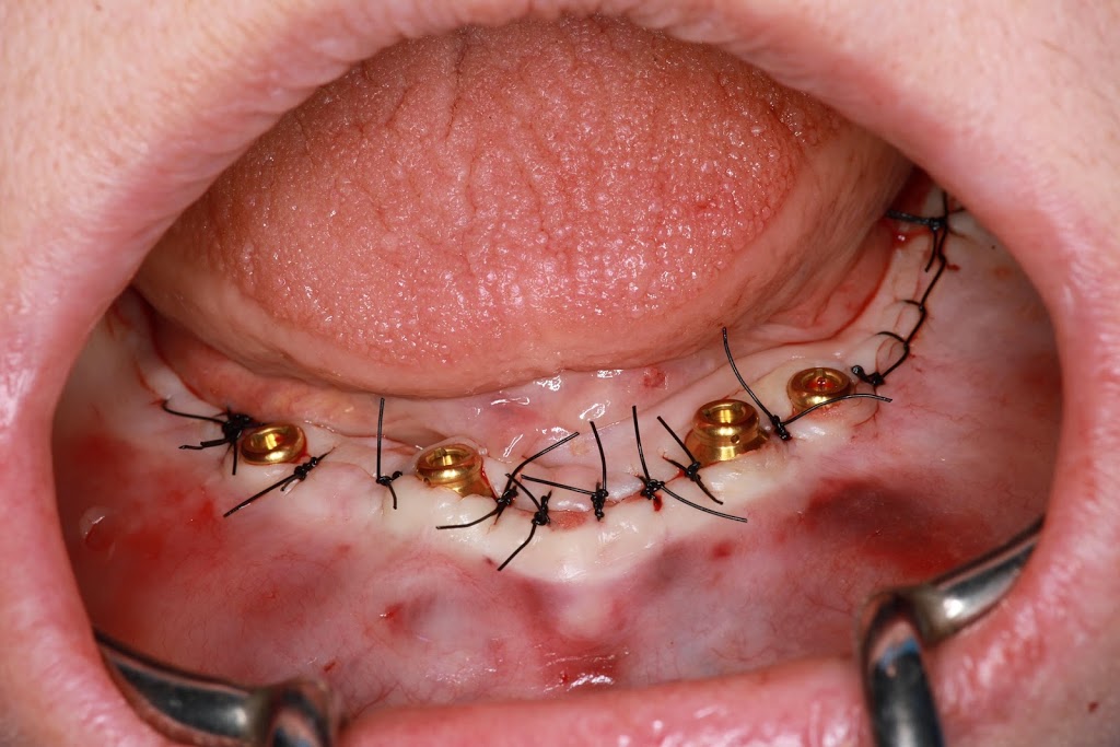 Kasper Denture clinic ltd | 1710 Ellis St Suite 25, Kelowna, BC V1W 3S9, Canada | Phone: (250) 717-3730