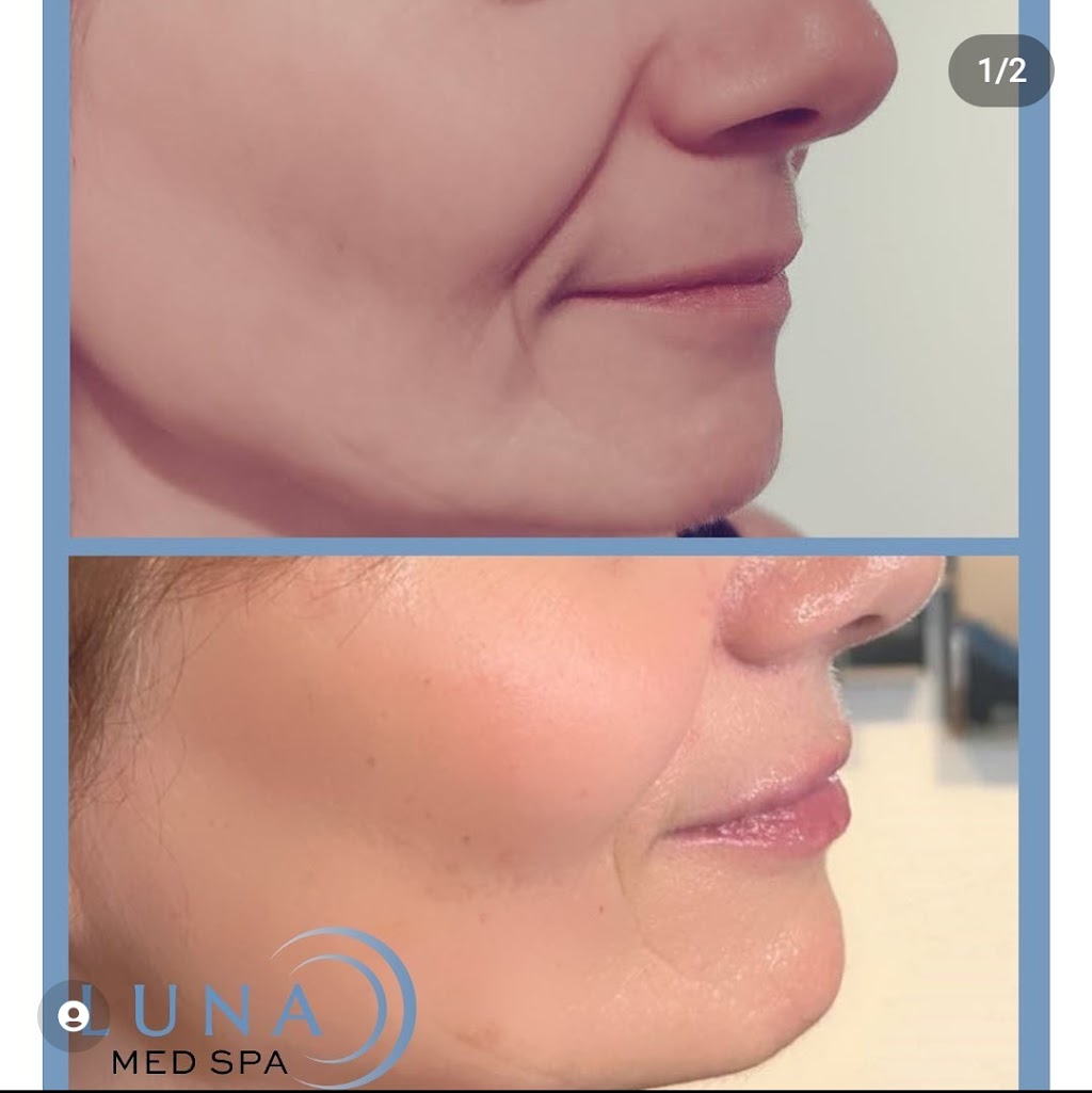 Luna Med Spa | RCI & MedSpa Group, 5045 Mainway Suite 201, Burlington, ON L7L 5Z1, Canada | Phone: (905) 981-8454