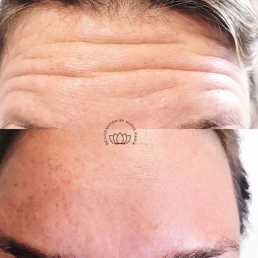 New Tec Cosmetic Rejuvenation | 35 Wolfe Ave Tottenham L0G1W0, 100 Bass Pro Mills Dr Unit 42, Vaughan, ON L4K 5X1, Canada | Phone: (416) 605-3646