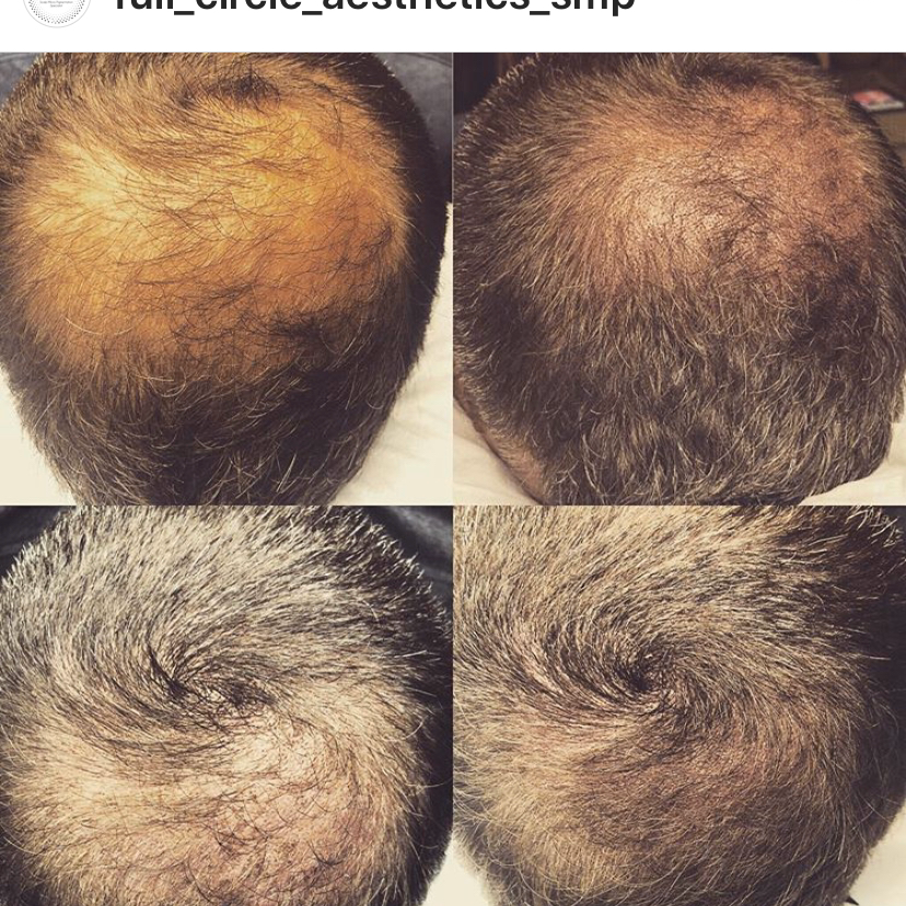 Royal Scalp and Brows - Scalp Micropigmentation and Microblading | 22366 Dewdney Trunk Rd, Maple Ridge, BC V2X 3J2, Canada | Phone: (778) 888-1557