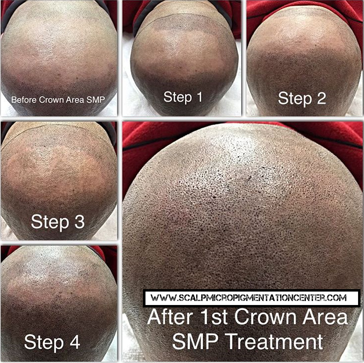 Scalp Micropigmentation London | 328 Glenrose Dr, London, ON N6K 2A8, Canada | Phone: (519) 881-6044