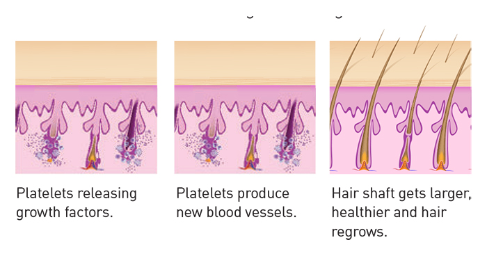 Aurora Hair Loss Clinic | 372 Hollandview Trail unit 302, Aurora, ON L4G 0A5, Canada | Phone: (905) 503-4001