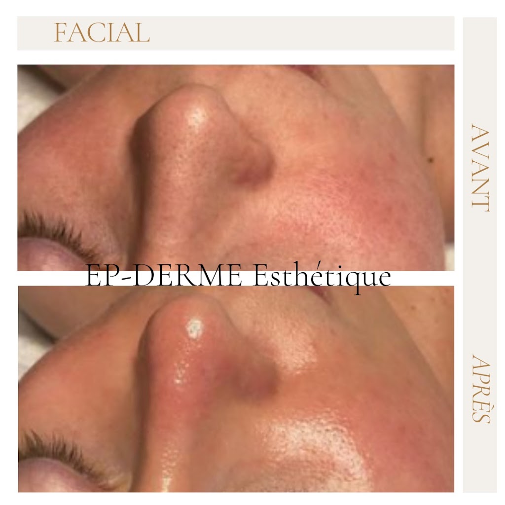 EP-DERME Esthétique - Microdermabrasion - Mont-Laurier | 2322 Chemin du Rang 4 S, Mont-Laurier, QC J9L 3G3, Canada | Phone: (819) 616-7888
