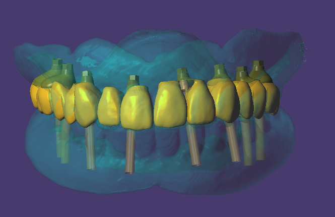 Bellwether Dental Implants & Oral Surgery | 12 Bellwether Way Ste 114, Bellingham, WA 98225, USA | Phone: (360) 366-8026