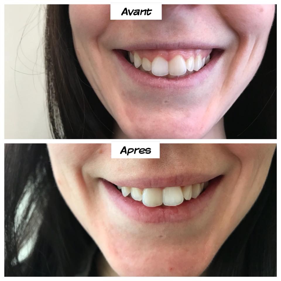 Clinique Medispa | 201 Rue Champlain Local 202, Bromont, QC J2L 3B2, Canada | Phone: (450) 726-9050